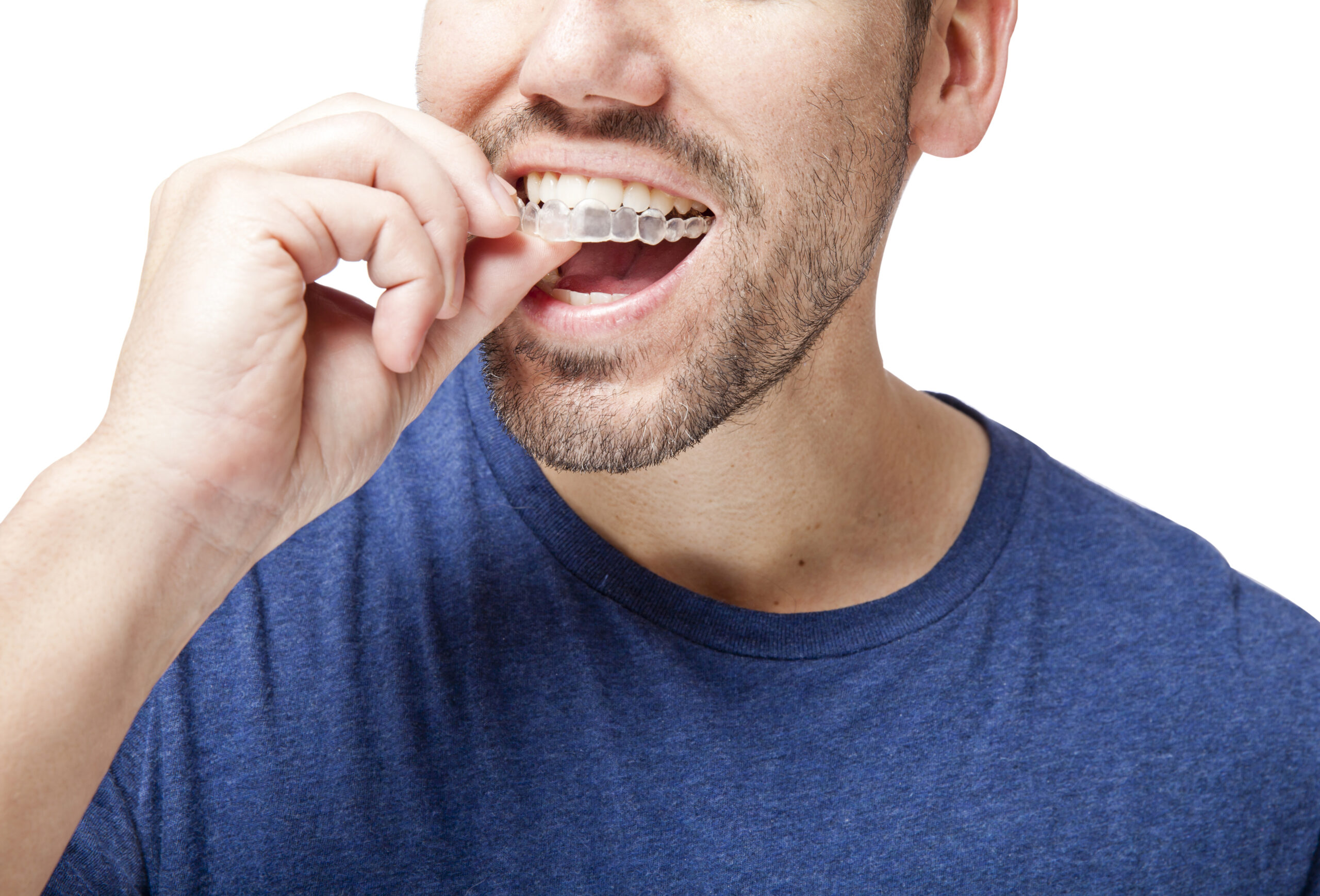 15 facts you need to know about invisalign